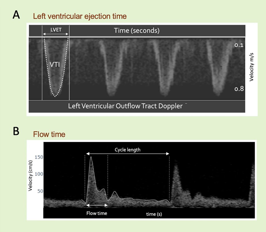 FloPatch | Flosonics Medical (@flosonics) on Twitter photo 📝 New in The Ultrasound Journal: Dr. Jon-Emile S. Kenny's article, "A framework for flow time measured by Doppler ultrasound," outlines FT (or ccFT via FloPatch) as a physiologic surrogate for stroke volume.
📖 Read it here: hubs.ly/Q03jL-LC0
<a href="/WINFOCUSTUJ/">WINFOCUS - The Ultrasound Journal</a>
#POCUS #LVOT 📝 New in The Ultrasound Journal: Dr. Jon-Emile S. Kenny's article, "A framework for flow time measured by Doppler ultrasound," outlines FT (or ccFT via FloPatch) as a physiologic surrogate for stroke volume.
📖 Read it here: hubs.ly/Q03jL-LC0
<a href="/WINFOCUSTUJ/">WINFOCUS - The Ultrasound Journal</a>
#POCUS #LVOT