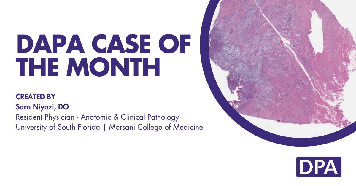 A 45-year-old woman presents with vague abdominal pain and altered bowel habits. During a colonoscopy, a 3.4 cm mass is discovered in the right colon and resected. The histology reveals a striking pattern. Take the assessment and test your knowledge: zurl.co/osaJw