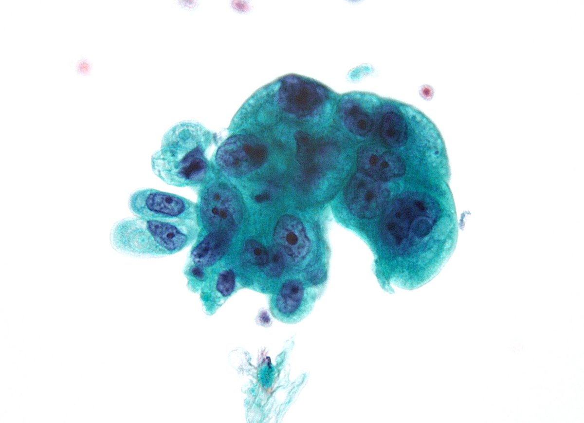 Tubular GI tract cytologic brushings are rarely performed in our practice at Hopkins. Here is a case with a slam-dunk diagnosis of "Adenocarcinoma" from a gastric brushing.