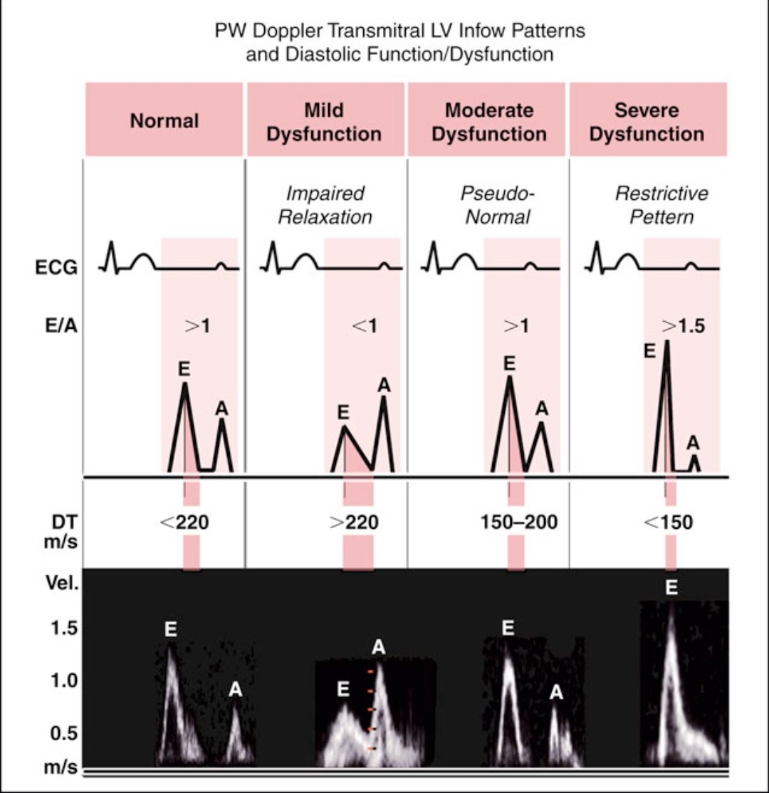 Understanding LV Diastolic Dysfunction via Mitral Inflow Doppler:

Mitral inflow Doppler patterns reflect LV diastolic function. Pulsed-wave Doppler at the mitral valve leaflets shows E (early filling) and A (atrial contraction) waves.

Here’s how the patterns change:

1️⃣ Normal