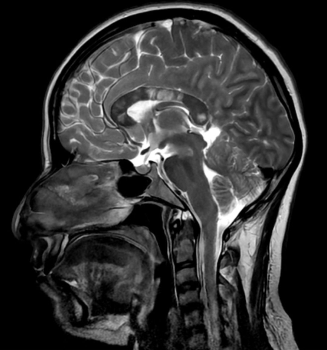 33 yo female with encephalopathy and visual impairement #neurorad #FOAMrad