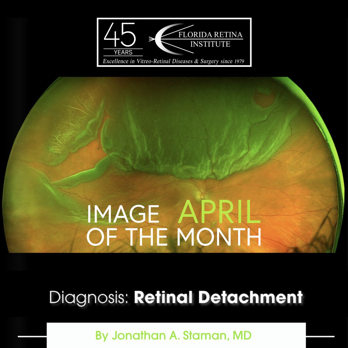 floridaretina's tweet image. Florida Retina Institute’s April Image of the Month. Diagnosis: Retinal Detachment, Captured by Dr. Jonathan A. Staman, this powerful image highlights the urgency of expert retina care.
Learn more at floridaretinainstitute.com
#retinaldetachment #imageofthemonth #eyehealth