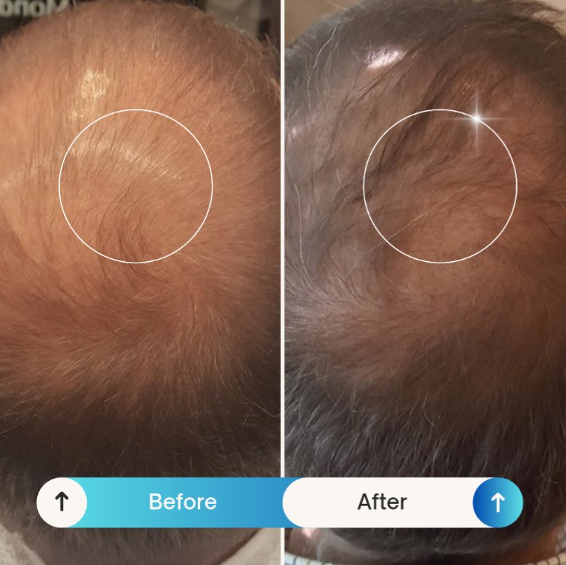 MoreHairNatural's tweet photo. Witness the power of nature! Just 8 weeks of using our all-natural hair growth solution brought these incredible results — thicker, healthier hair with zero chemicals and 100% plant-based ingredients.

https://t.co/zdcqgD5Wxv https://t.co/bRyNEmVmi4