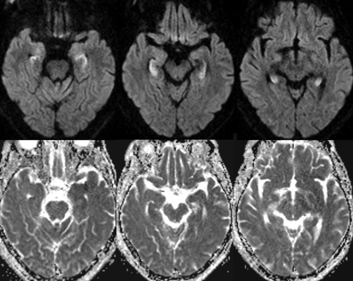 Daniel Gewolb, MD (@daniel_gewolb) on Twitter photo ⭐️ What is the most likely diagnosis in this 45 y/o M found down with history of polysubstance abuse?
#Neurology #Medicine #radres #Neurosurgery #futureradres #radres #FOAMed #MRI <a href="/AlbanyMedRadRes/">Albany Med Radiology Residency</a> <a href="/TheASNR/">The American Society of Neuroradiology</a> ⭐️ What is the most likely diagnosis in this 45 y/o M found down with history of polysubstance abuse?
#Neurology #Medicine #radres #Neurosurgery #futureradres #radres #FOAMed #MRI <a href="/AlbanyMedRadRes/">Albany Med Radiology Residency</a> <a href="/TheASNR/">The American Society of Neuroradiology</a>