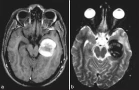 Aneurysm or brain tumor?  (Source SNI)
