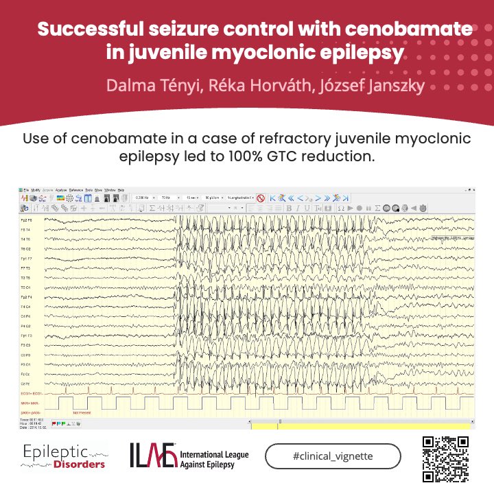 Epileptic Disorders (@epidisorders) on Twitter photo Tenyi, Horvath, and Jansky report on cenobamate use in Juvenile Myoclonic Epilepsy (JME), showing promising results with a cessation of generalized tonic-clonic seizures.
🔗 doi.org/10.1002/epd2.2…
<a href="/GiovanniFa83566/">Giovanni Falcicchio</a> <a href="/AlinaIvaniuk/">Alina Ivaniuk 🇺🇦</a> <a href="/SheikhISMD/">irfan sheikh 伊凡</a> <a href="/joanajribeiro/">Joana Ribeiro</a> <a href="/SBeniczky/">Sandor Beniczky</a> <a href="/AnphyLab/">The AnPhy Lab</a> Tenyi, Horvath, and Jansky report on cenobamate use in Juvenile Myoclonic Epilepsy (JME), showing promising results with a cessation of generalized tonic-clonic seizures.
🔗 doi.org/10.1002/epd2.2…
<a href="/GiovanniFa83566/">Giovanni Falcicchio</a> <a href="/AlinaIvaniuk/">Alina Ivaniuk 🇺🇦</a> <a href="/SheikhISMD/">irfan sheikh 伊凡</a> <a href="/joanajribeiro/">Joana Ribeiro</a> <a href="/SBeniczky/">Sandor Beniczky</a> <a href="/AnphyLab/">The AnPhy Lab</a>