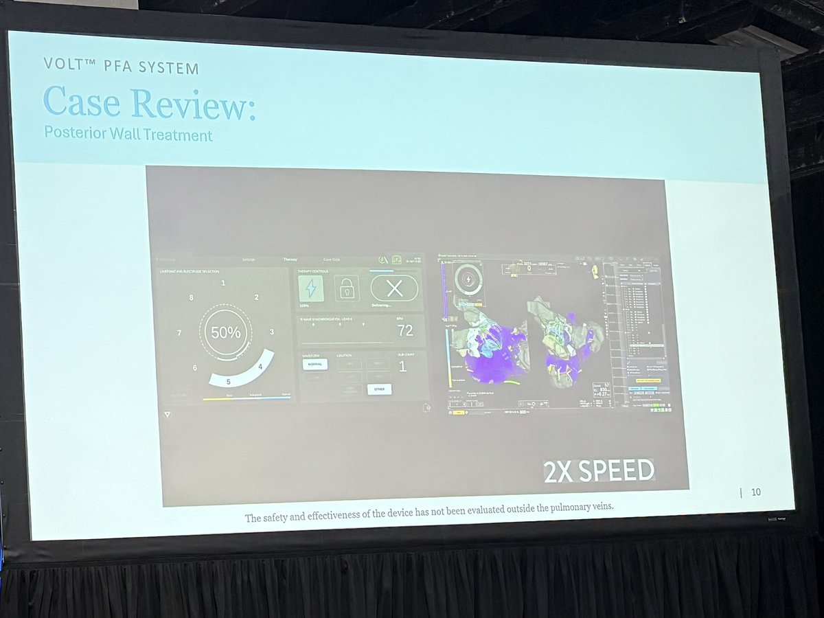 Sachin Vadodaria (@sachinjv) on Twitter photo Prof <a href="/purerfellner/">Dr. Helmut Pürerfellner</a> shares his case workflow with #VoltPFA during a case including a roof vein, posterior wall isolation & #HDGrid mapping. eField projection along w/ selectable electrodes shows where the lesions are for the isolation needed.
Safety info: cardiovascular.abbott/us/en/hcp/prod… Prof <a href="/purerfellner/">Dr. Helmut Pürerfellner</a> shares his case workflow with #VoltPFA during a case including a roof vein, posterior wall isolation & #HDGrid mapping. eField projection along w/ selectable electrodes shows where the lesions are for the isolation needed.
Safety info: cardiovascular.abbott/us/en/hcp/prod…