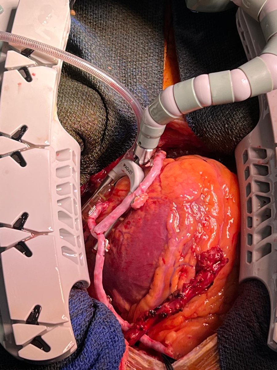 Shahzad Raja (@shahzad77891064) on Twitter photo There is always enough conduit......if the surgeon is a specialist coronary surgeon. A composite Y-graft between vein graft to PDA and vein graft to OM.
<a href="/Coronary4front/">Coronary 4Front</a>
<a href="/GianTorre610/">Gianluca Torregrossa</a>
<a href="/TulioCaldonazo/">Tulio Caldonazo</a>
<a href="/FaisalBakaeen/">Faisal Bakaeen MD</a>
#specialistcoronarysurgeon #CABG #OPCAB There is always enough conduit......if the surgeon is a specialist coronary surgeon. A composite Y-graft between vein graft to PDA and vein graft to OM.
<a href="/Coronary4front/">Coronary 4Front</a>
<a href="/GianTorre610/">Gianluca Torregrossa</a>
<a href="/TulioCaldonazo/">Tulio Caldonazo</a>
<a href="/FaisalBakaeen/">Faisal Bakaeen MD</a>
#specialistcoronarysurgeon #CABG #OPCAB