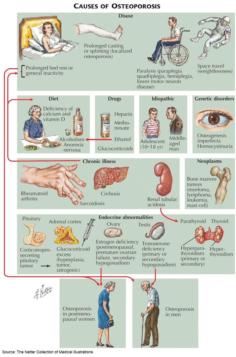 OGdukeneurosurg's tweet photo. Osteoporosis https://t.co/wpQWkmYZKW