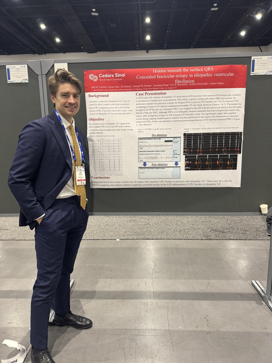 Ashkan Ehdaie MD (@ehdaiemd) on Twitter photo The spectrum of clinical science on showcase by the #CedarsSinaiEP group today #HRS2025 💪💪🔥
-Premature battery depletion
-Idiopathic VF ablation
-Snaring leadless pacemakers
-Linear PFA w/ pentaspline catheter
More to come tomorrow!!
<a href="/MdSimsolo/">Eli Simsolo, MD</a> <a href="/jess_mao/">Jessica Mao</a> <a href="/JoMiCoMD/">John M Cochran</a> The spectrum of clinical science on showcase by the #CedarsSinaiEP group today #HRS2025 💪💪🔥
-Premature battery depletion
-Idiopathic VF ablation
-Snaring leadless pacemakers
-Linear PFA w/ pentaspline catheter
More to come tomorrow!!
<a href="/MdSimsolo/">Eli Simsolo, MD</a> <a href="/jess_mao/">Jessica Mao</a> <a href="/JoMiCoMD/">John M Cochran</a>