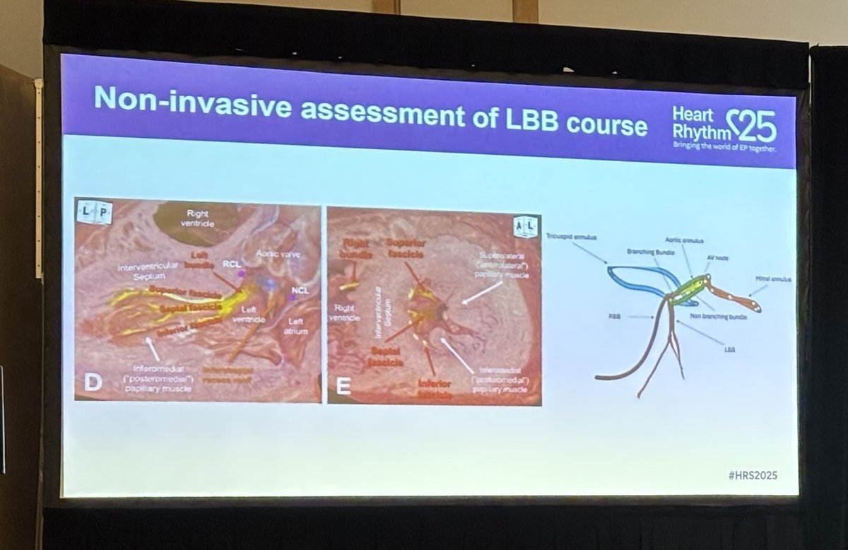 JustinTretterMD's tweet photo. Excellent presentation by @shunmug_his_mdu #HRS2025 of our work on using #cardiacCT anatomy to guide conduction system pacing at Conduction System Pacing Symposium.

Join late breaking session tomorrow to learn more how this can impact outcomes:
 https://t.co/TqBNoovXF0 #HRS2025 https://t.co/UcbfTizgvG