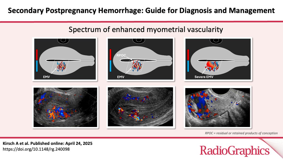 UCSF Imaging (@ucsfimaging) on Twitter photo A powerhouse team of <a href="/UCSFimaging/">UCSF Imaging</a> researchers breaks down placental physiology, causes & imaging of secondary postpartum hemorrhage (PPH) & offers a diagnostic algorithm for radiologists. More in <a href="/RSNA/">RSNA</a> <a href="/RadioGraphics/">RadioGraphics</a>: doi.org/10.1148/rg.240… A powerhouse team of <a href="/UCSFimaging/">UCSF Imaging</a> researchers breaks down placental physiology, causes & imaging of secondary postpartum hemorrhage (PPH) & offers a diagnostic algorithm for radiologists. More in <a href="/RSNA/">RSNA</a> <a href="/RadioGraphics/">RadioGraphics</a>: doi.org/10.1148/rg.240…