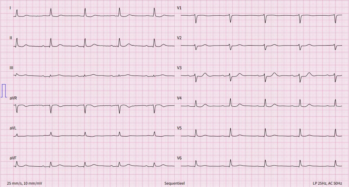70-year-old female patient presents with chest pain and this #ECG.

ER letter reads: "No signs of acute ischemia, ST depression V3-V4"

Do you agree?
