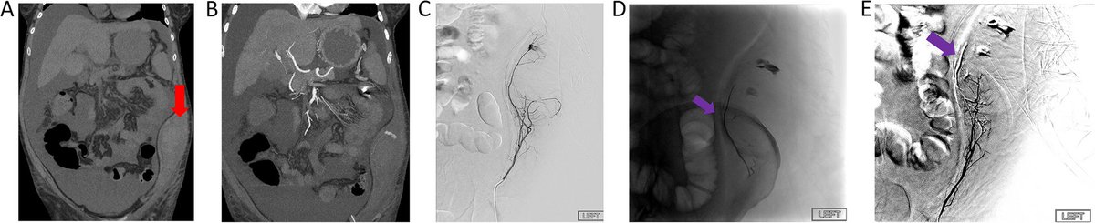 This article explores a novel conformable embolic for selective transarterial embolization of acute hemorrhages: a technical note

cvirendovasc.springeropen.com/articles/10.11…

#irad #interventionalradiology