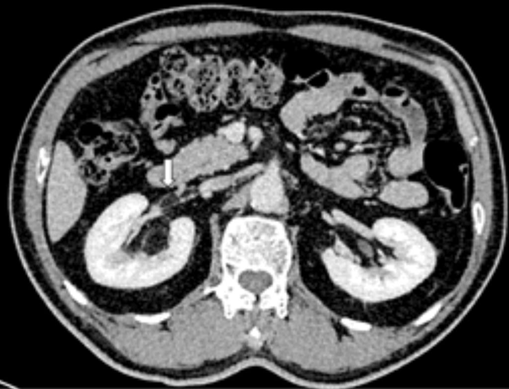 Images_Case's tweet photo. Aggressive Renal Angiomyolipoma with Renal Vein Thrombosis: A Rare Complication: Renal angiomyolipoma (AML) is the most common type of benign mesenchymal tumour of the kidney. It is most often discovered incidentally on imaging, presented as a benign...https://t.co/Ar8dpL8XHe https://t.co/a6Fe2fpv6S