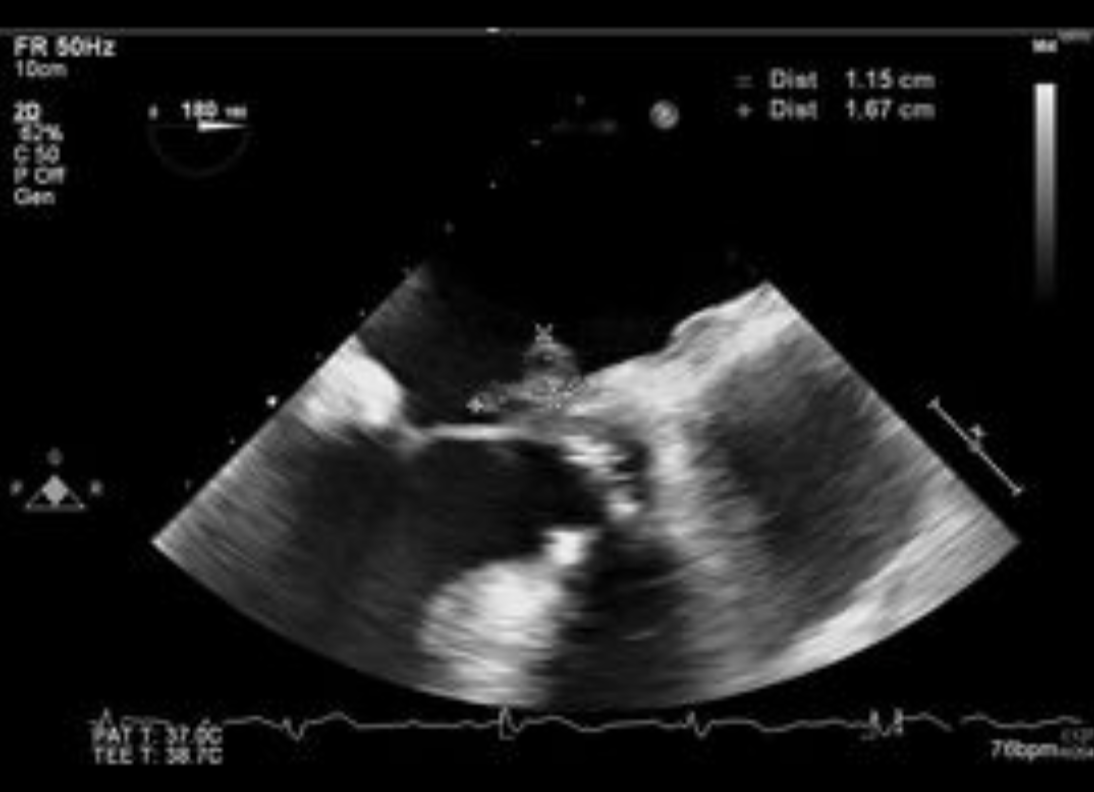 Images_Case's tweet photo. Aortic Prosthetic Endocarditis with Peri-prosthetic Abscess: A 85-year-old male with history of heart failure, biological aortic prosthesis and atrial fibrillation was hospitalized for urinary septic shock to Escherichia coli and was treated with empiric...https://t.co/BSy4yRTIf1 https://t.co/qg8bUubZn0