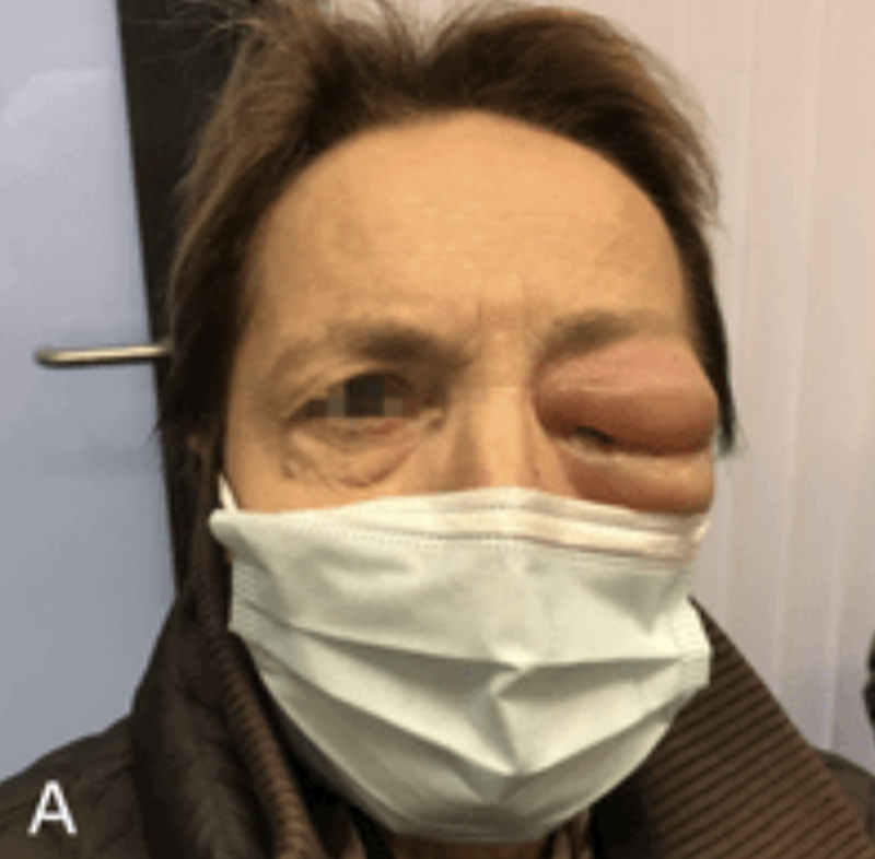Images_Case's tweet photo. Recall Phenomenon After Intracranial Stereotactic Radiotherapy: Illustration of a Palpebral Reaction: A 57-year-old woman, known for metastatic breast cancer, presented in November 2020 with a newly left intraorbital metastasis on MRI. The patient had...https://t.co/z4lrTIZmsl https://t.co/VmrgOQwM7E