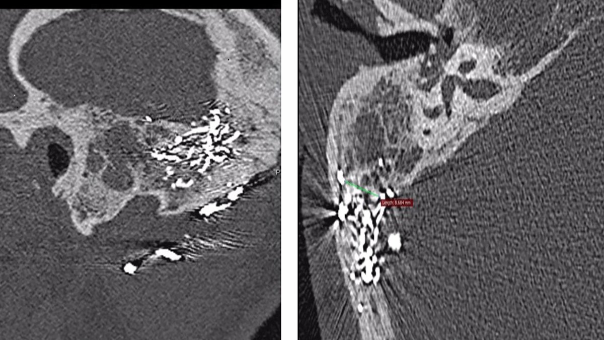 #LettertoEditor 📬
A Rare Case of #Cholesterol Granuloma as a Complication of Onyx Embolization for Dural Arteriovenous Fistula
link.springer.com/article/10.100…