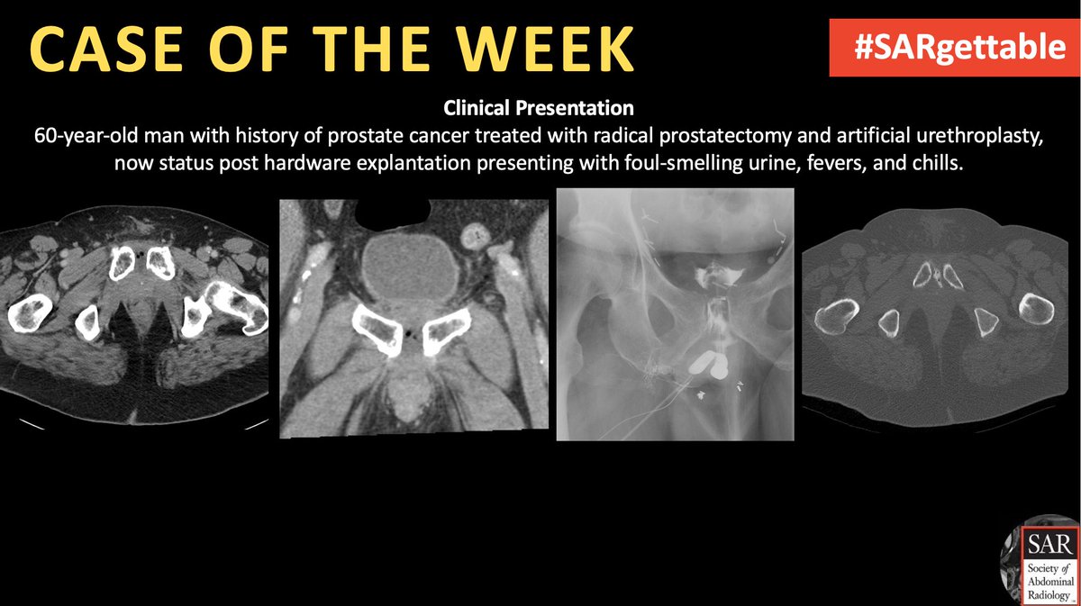 Society of Abdominal Radiology | SAR (@societyabdrad) on Twitter photo It's time for a new #SARgettable case of the week contributed by <a href="/danieldfriedman/">Daniel Friedman, MD</a>, <a href="/MIRimaging/">WashUMedMIR</a> and <a href="/ItaniMalak/">Malak Itani</a>. Comment with your diagnosis down below! It's time for a new #SARgettable case of the week contributed by <a href="/danieldfriedman/">Daniel Friedman, MD</a>, <a href="/MIRimaging/">WashUMedMIR</a> and <a href="/ItaniMalak/">Malak Itani</a>. Comment with your diagnosis down below!