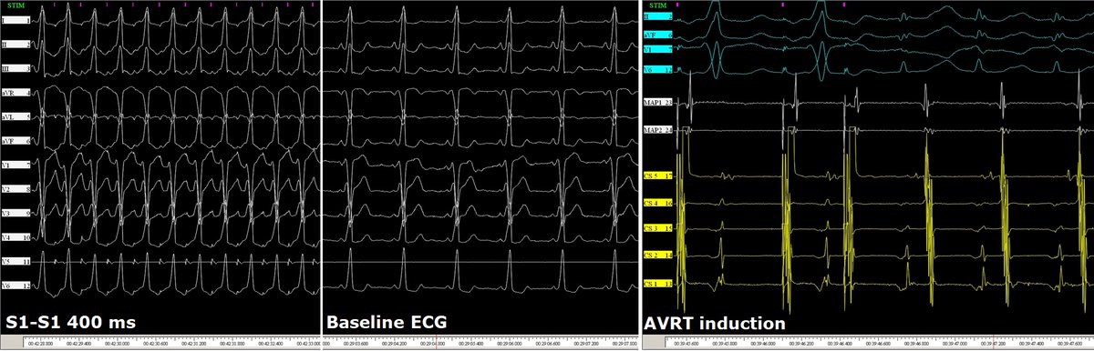 messapus's tweet image. A 58M was referred for redo #ablation of a right anterior para-septal manifest accessory pathway with frequent AVRT episodes. AP gone after careful mapping and about 1 s radiofrequency in the sweet spot.🔥No need for fluoroscopy! #NoFluoro #MapMoreBurnLess #Epeeps