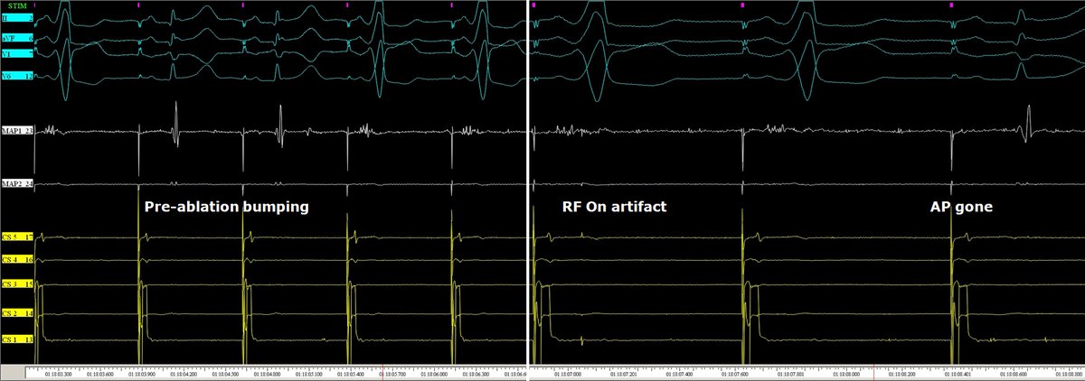 messapus's tweet image. A 58M was referred for redo #ablation of a right anterior para-septal manifest accessory pathway with frequent AVRT episodes. AP gone after careful mapping and about 1 s radiofrequency in the sweet spot.🔥No need for fluoroscopy! #NoFluoro #MapMoreBurnLess #Epeeps