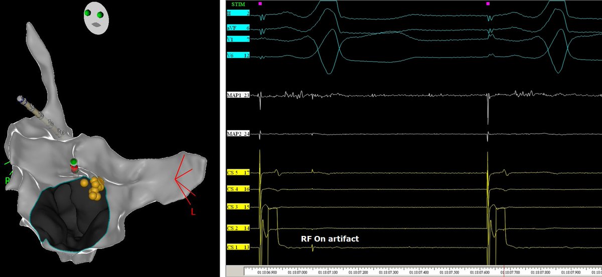 messapus's tweet image. A 58M was referred for redo #ablation of a right anterior para-septal manifest accessory pathway with frequent AVRT episodes. AP gone after careful mapping and about 1 s radiofrequency in the sweet spot.🔥No need for fluoroscopy! #NoFluoro #MapMoreBurnLess #Epeeps