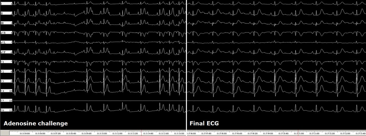 Giovanni Coluccia (@messapus) on Twitter photo A 58M was referred for redo #ablation of a right anterior para-septal manifest accessory pathway with frequent AVRT episodes. AP gone after careful mapping and about 1 s radiofrequency in the sweet spot.🔥No need for fluoroscopy! #NoFluoro #MapMoreBurnLess #Epeeps A 58M was referred for redo #ablation of a right anterior para-septal manifest accessory pathway with frequent AVRT episodes. AP gone after careful mapping and about 1 s radiofrequency in the sweet spot.🔥No need for fluoroscopy! #NoFluoro #MapMoreBurnLess #Epeeps