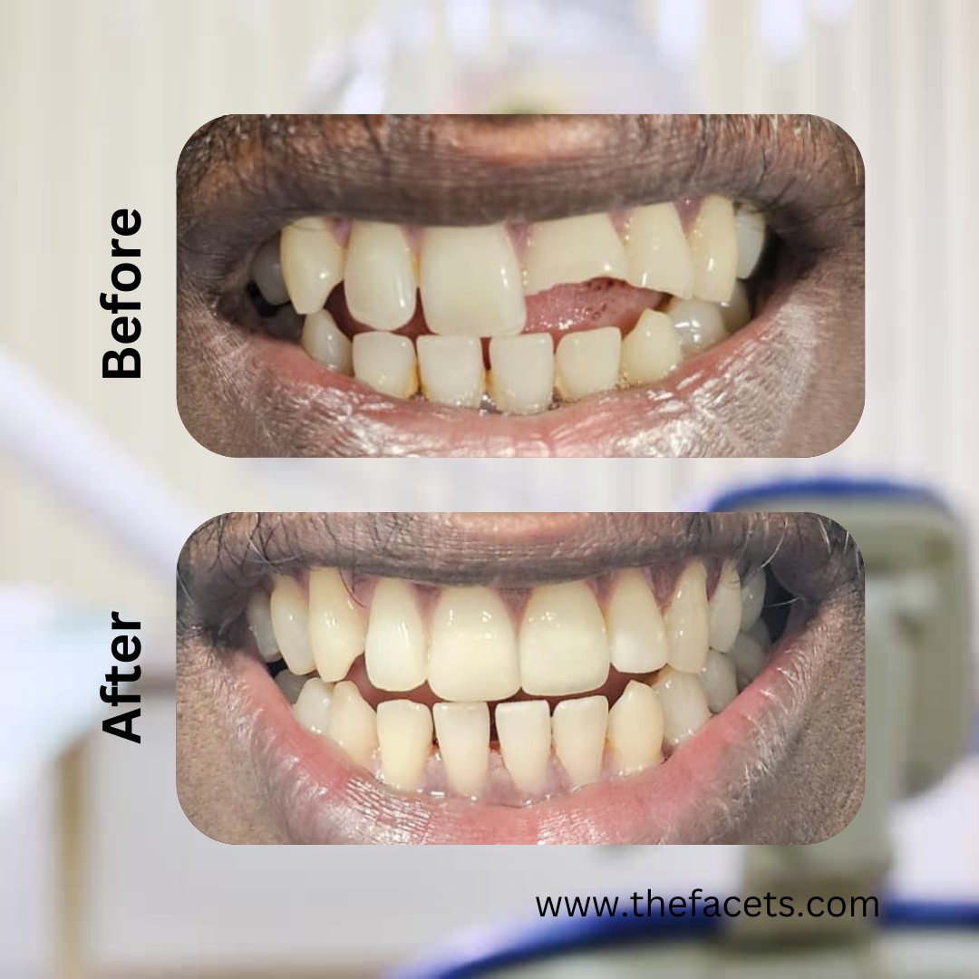 Restore Your Smile with Handcrafted Composite Bonding

A broken tooth doesn't have to break your confidence at Facets Dental, where 25 years of trust and excellence meet world-class expertise

Call/Whatsapp: +91 90 20 160 160

Visit Us: thefacets.com
