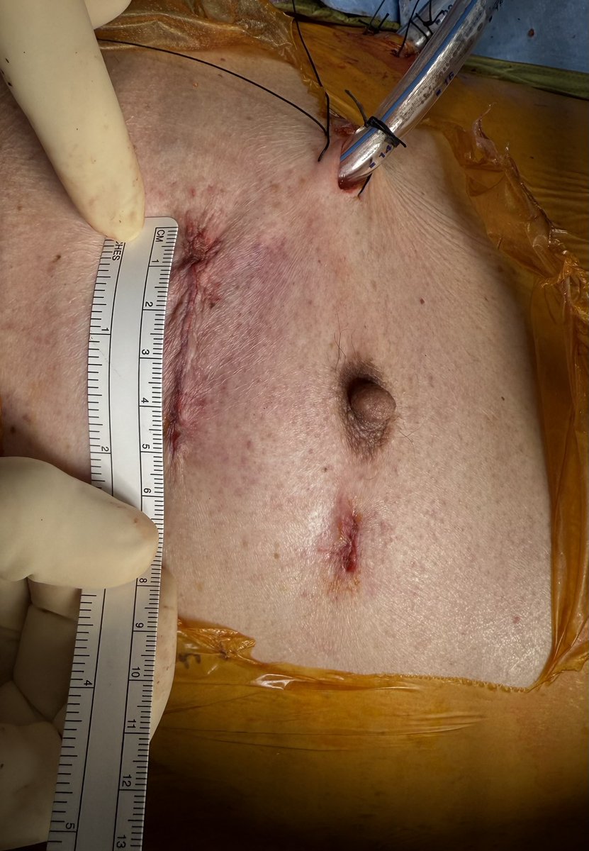 There were some questions on what the incision from a #robotic #lungtransplant really looks like (with pt permission). This is a recent one we did, 5-6 cm incision (to insert the donor lung), no rib spreading. Much easier on the patient! #ISHLT2025 #transplant