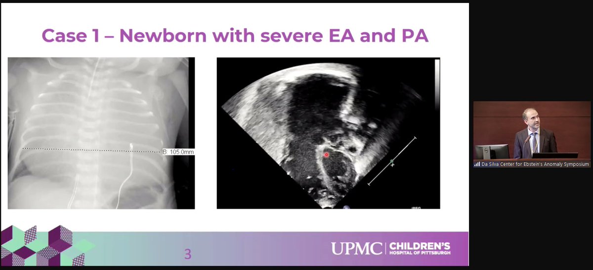 UPMC Heart and Vascular Institute (@hviupmc) on Twitter photo Join us virtually! Currently, <a href="/AlsaiedTarek/">Tarek Alsaied</a> is presenting "Imaging after Starnes Procedure Preparing for the Cone".
Join here: cce.upmc.com/5th-annual-upm… Join us virtually! Currently, <a href="/AlsaiedTarek/">Tarek Alsaied</a> is presenting "Imaging after Starnes Procedure Preparing for the Cone".
Join here: cce.upmc.com/5th-annual-upm…