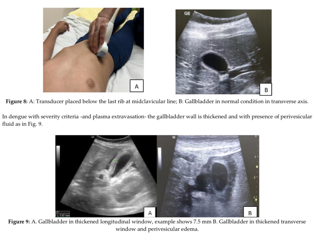 Protocolo AEDES de #POCUS para pacientes con pediátricos con Dengue, pero podría ser aplicado para adultos de igual forma 🦠 🦟

De mi amigo <a href="/CantillMauricio/">Mauricio Cantillano</a> y cols:

athenaeumpub.com/proposed-proto…