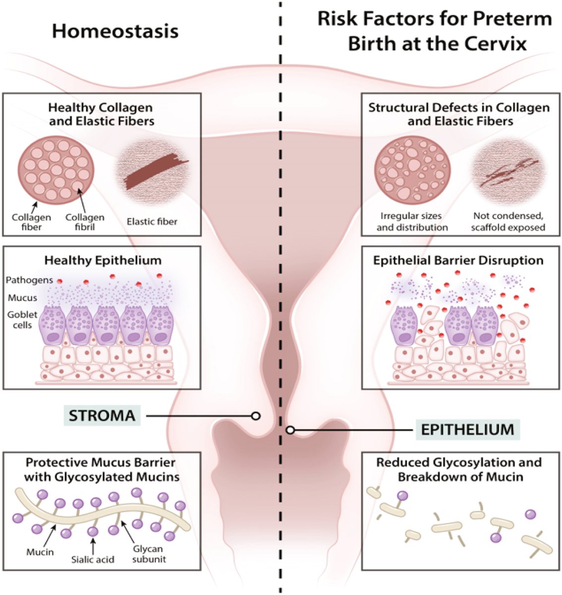 AJOG Expert Review:  Cervical function in pregnancy and disease: new insights from single-cell analysis -  Cervical risk factors for preterm birth ajog.org/article/S0002-…