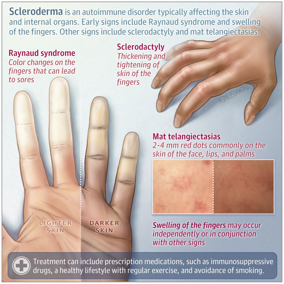 JAMA Dermatology (@jamaderm) on Twitter photo Most viewed in the last 7 days from <a href="/JAMADerm/">JAMA Dermatology</a>:
This Patient Page describes the symptoms, diagnosis, and treatment of scleroderma.
ja.ma/42Hgfax Most viewed in the last 7 days from <a href="/JAMADerm/">JAMA Dermatology</a>:
This Patient Page describes the symptoms, diagnosis, and treatment of scleroderma.
ja.ma/42Hgfax