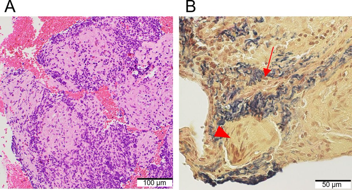 Vasodilator-induced selective pulmonary oedema in sarcoidosis-associated pulmonary hypertension with pulmonary venous stenosis. thorax.bmj.com/content/80/5/3…