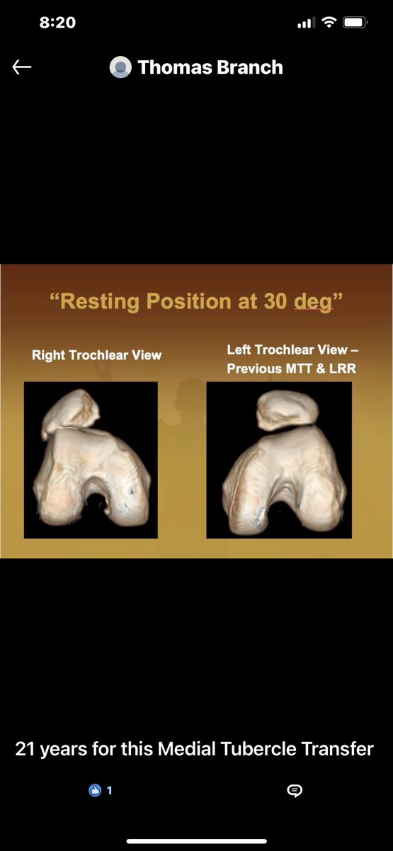 Tibial tubercle transfer yields joint preservation in patella instability patients