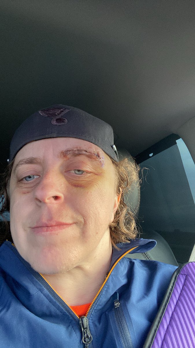 Stitch out still hurts but getting better