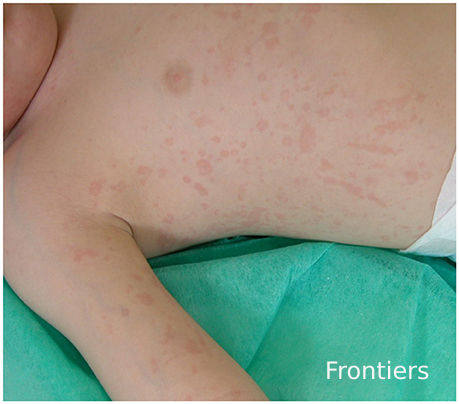 Rosa Taberner (@rosataberner) on Twitter photo Enfermedad de Still del adulto. Esta semana en <a href="/dermapixel/">Dermapixel</a>
dermapixel.com/2025/04/enferm…
#dermatología #reumatología Enfermedad de Still del adulto. Esta semana en <a href="/dermapixel/">Dermapixel</a>
dermapixel.com/2025/04/enferm…
#dermatología #reumatología