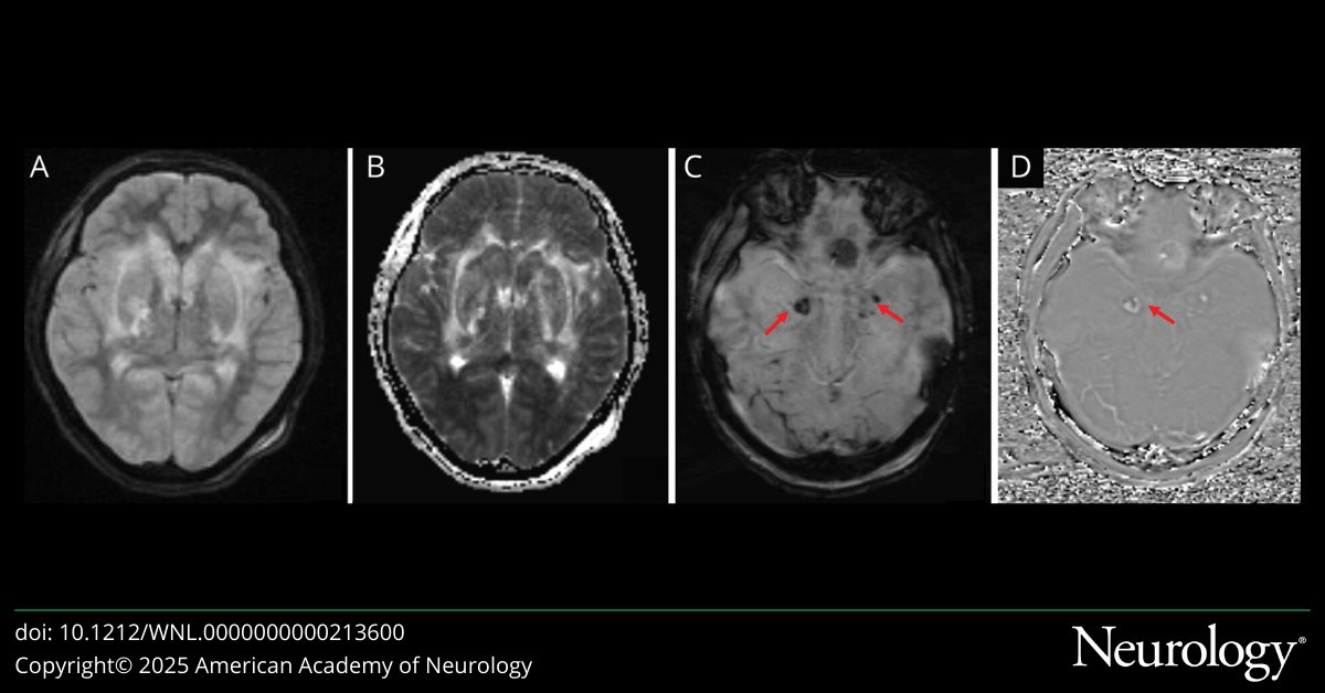 Acute Hemorrhagic Leucoencephalitis: A Rare CNS Complication of Abrus precatorius Poisoning
hubs.la/Q03jNSdp0

#NeuroX