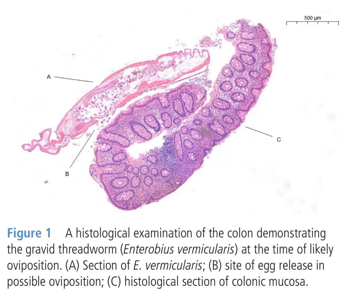 Keith Siau (@drkeithsiau) on Twitter photo This is a threadworm (Enterobius vermicularis). This <a href="/FrontGastro_BMJ/">Frontline Gastro</a> case reports shows a biopsy capturing a gravid (pregnant) threadworm just before eggs (in their 1000s) are laid in the rectal mucosa. If you see one of these, there are usually others!
fg.bmj.com/content/early/โฆ This is a threadworm (Enterobius vermicularis). This <a href="/FrontGastro_BMJ/">Frontline Gastro</a> case reports shows a biopsy capturing a gravid (pregnant) threadworm just before eggs (in their 1000s) are laid in the rectal mucosa. If you see one of these, there are usually others!
fg.bmj.com/content/early/โฆ
