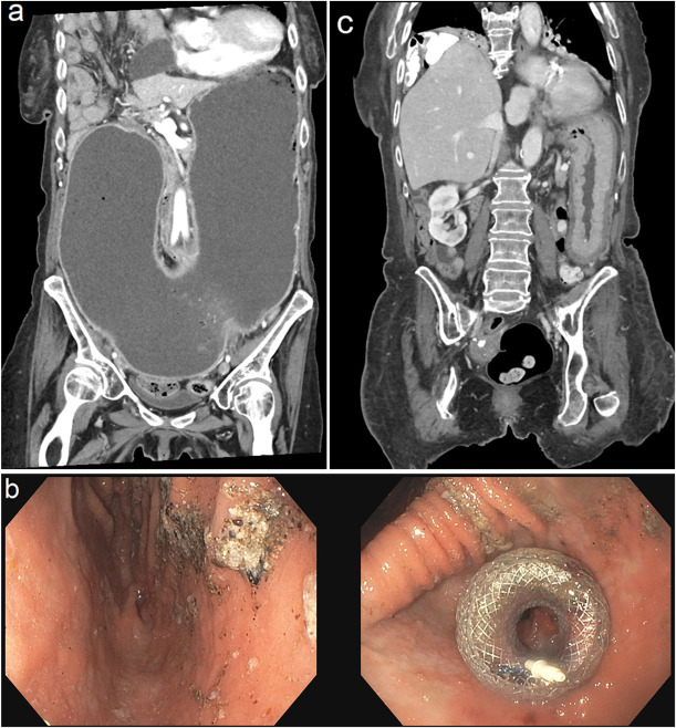 From GHA ➡️ A 77-year-old female was found to have massive gastric dilation due to recurrent benign idiopathic pre-pyloric stenosis and was managed with lumen-apposing metal stent.

🔗 ow.ly/9Z3p50VGlEC