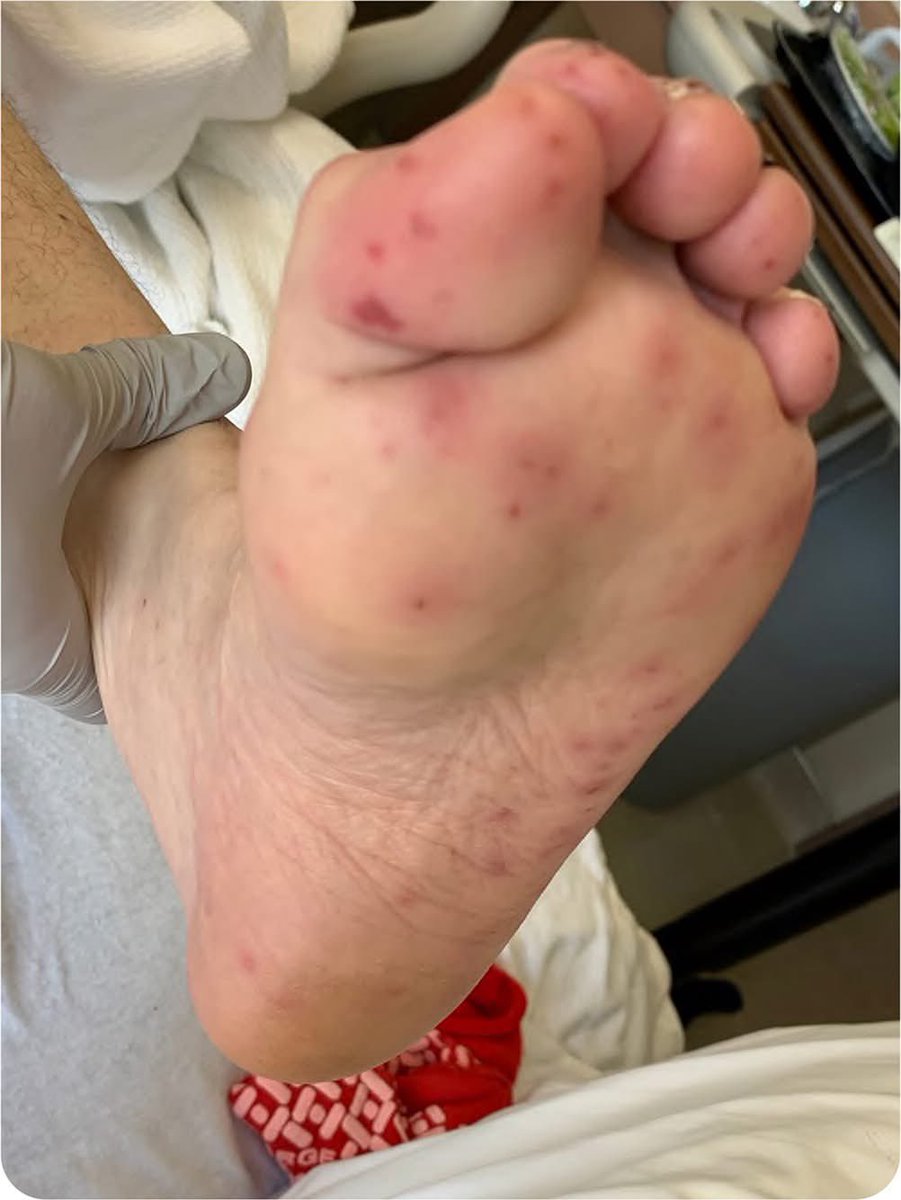 A patient presents with fever, chills, night sweats, and generalized fatigue for the past 2 weeks. 

What is the diagnosis?

#MedX #MEDHM <a href="/IhabFathiSulima/">Dr Ihab Suliman</a>