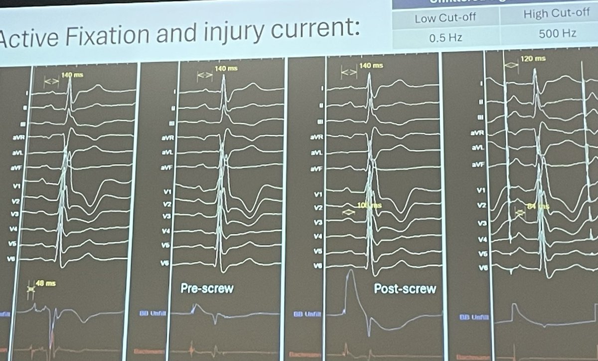 Sandeep Gautam (@gautamsand) on Twitter photo Masterclass on Bachman Bundle Pacing <a href="/lusty63/">Dan Lustgarten MDPhD</a> <a href="/HRSonline/">Heart Rhythm Society</a> <a href="/hrs_journal/">HeartRhythm</a> #HRS2025
⭐️ Inferoseptal SVC RA Junction
⭐️Use local fractionated EGM for guidance
⭐️Narrow P wave with sharp inferior axis
⭐️High initial threshold with rapid improvement
⭐️Watch for unfiltered injury Masterclass on Bachman Bundle Pacing <a href="/lusty63/">Dan Lustgarten MDPhD</a> <a href="/HRSonline/">Heart Rhythm Society</a> <a href="/hrs_journal/">HeartRhythm</a> #HRS2025
⭐️ Inferoseptal SVC RA Junction
⭐️Use local fractionated EGM for guidance
⭐️Narrow P wave with sharp inferior axis
⭐️High initial threshold with rapid improvement
⭐️Watch for unfiltered injury
