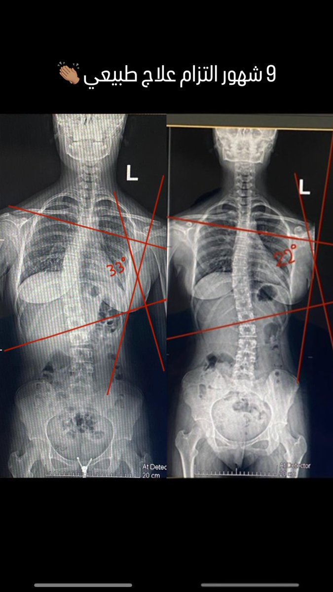 العلاج الطبيعي المتخصص لمشكلة الجنف‼️
مفيد وفعال جدا مع الحالات المتوسطة الى الخفيفة. 
يفضل عدم اتباع نظام المتابعة فقط خصوصا إذا كان العمر تقريبا ١٣-١٤ سنه وأصغر. 

نتائج مبهرة ومرضية لالتزام ممتاز مدته ٩ شهور 👏🏽