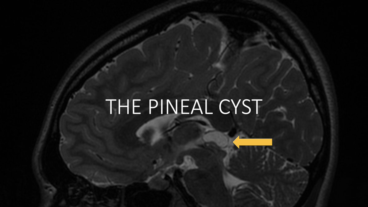 American Society of Pediatric Neuroradiology (@the_aspnr) on Twitter photo IPNTN: <a href="/laura1127md/">Laura Hayes</a> from <a href="/ChildrensATLRad/">Radiology Children's Healthcare of Atlanta</a> kicks us off with those pesky incidental-"oh no"-mas. Or perhaps what should be of greater concern to avoid...BARF VOMIT! 🤮 Brainless Application of Radiological Findings leads to Victims of Modern Imaging Technology. First up, IPNTN: <a href="/laura1127md/">Laura Hayes</a> from <a href="/ChildrensATLRad/">Radiology Children's Healthcare of Atlanta</a> kicks us off with those pesky incidental-"oh no"-mas. Or perhaps what should be of greater concern to avoid...BARF VOMIT! 🤮 Brainless Application of Radiological Findings leads to Victims of Modern Imaging Technology. First up,