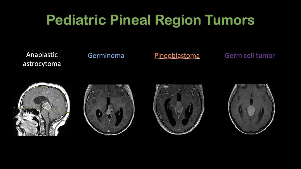 The_ASPNR's tweet photo. IPNTN: @laura1127md continues our tour of pineal cysts from the normal microcystic gland, to atypical appearances, to rare tumors. Can use the habenula as a benchmark. We're also learning more about symptomatic cysts, even from our patients in online support groups. And for pituitary incidentalomas, there's an app for that, coming soon! #InProgress #IPNTN