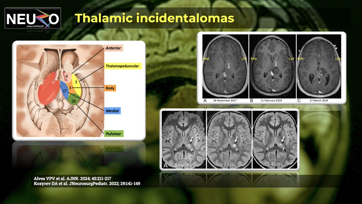 The_ASPNR's tweet photo. IPNTN: Next up, @LucatoLeandro from @HsvpSao raises the conundrum of incidental signal abnormalities in the brain. In demyelinating disease, we are learning that asymptomatic Radiologically Isolated Syndrome (RIS) can now suggest early signs of multiple sclerosis in some cases!

In tumefactive lesions of the thalamus and posterior fossa, we even observe that lesion progression on imaging does not always necessitate surgery and may remain stable on further surveillance.

#PediNeuroRad #IPNTN