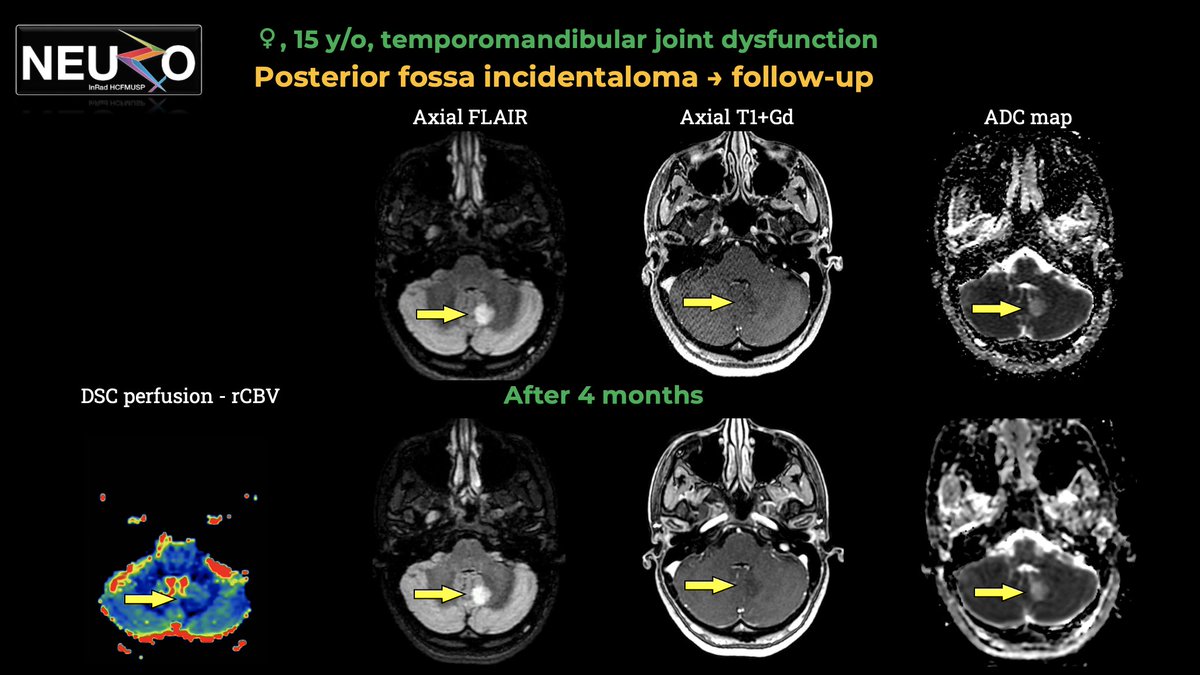 American Society of Pediatric Neuroradiology (@the_aspnr) on Twitter photo IPNTN: Next up, <a href="/LucatoLeandro/">Leandro Lucato</a> from <a href="/HsvpSao/">HSVP – HOSPITAL SÃO VICENTE DE PAULO</a> raises the conundrum of incidental signal abnormalities in the brain. In demyelinating disease, we are learning that asymptomatic Radiologically Isolated Syndrome (RIS) can now suggest early signs of multiple sclerosis in some cases! IPNTN: Next up, <a href="/LucatoLeandro/">Leandro Lucato</a> from <a href="/HsvpSao/">HSVP – HOSPITAL SÃO VICENTE DE PAULO</a> raises the conundrum of incidental signal abnormalities in the brain. In demyelinating disease, we are learning that asymptomatic Radiologically Isolated Syndrome (RIS) can now suggest early signs of multiple sclerosis in some cases!