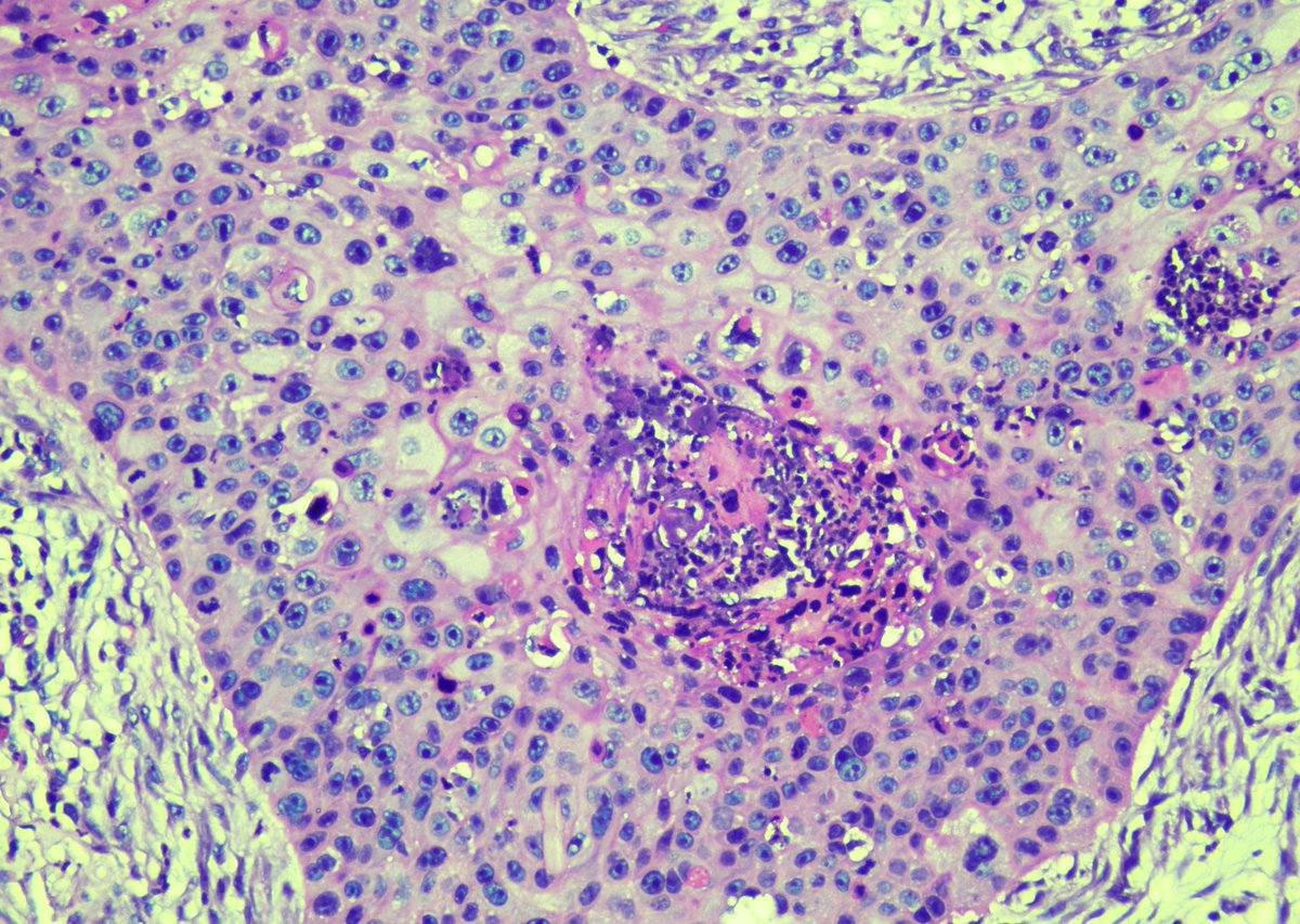 PathoGuy's tweet photo. A rare but extremely aggresive tumour of the conjunctiva. Treated by either surface plaque brachytherapy or enucleation. Who am I?
#PathTwitter #PathX #Pathology #OcularPath https://t.co/lAgU3hCGNg