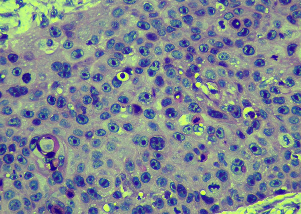 PathoGuy's tweet photo. A rare but extremely aggresive tumour of the conjunctiva. Treated by either surface plaque brachytherapy or enucleation. Who am I?
#PathTwitter #PathX #Pathology #OcularPath https://t.co/lAgU3hCGNg