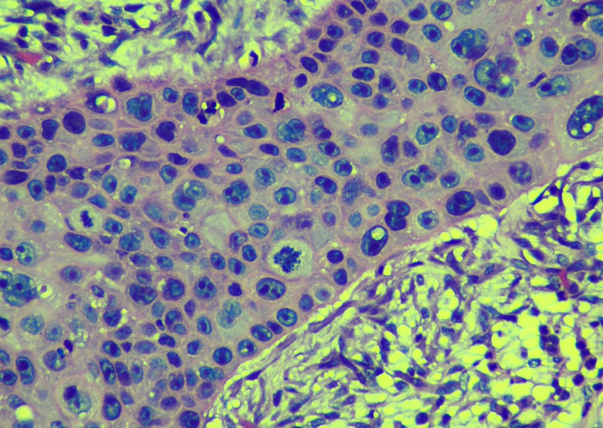PathoGuy's tweet photo. A rare but extremely aggresive tumour of the conjunctiva. Treated by either surface plaque brachytherapy or enucleation. Who am I?
#PathTwitter #PathX #Pathology #OcularPath https://t.co/lAgU3hCGNg